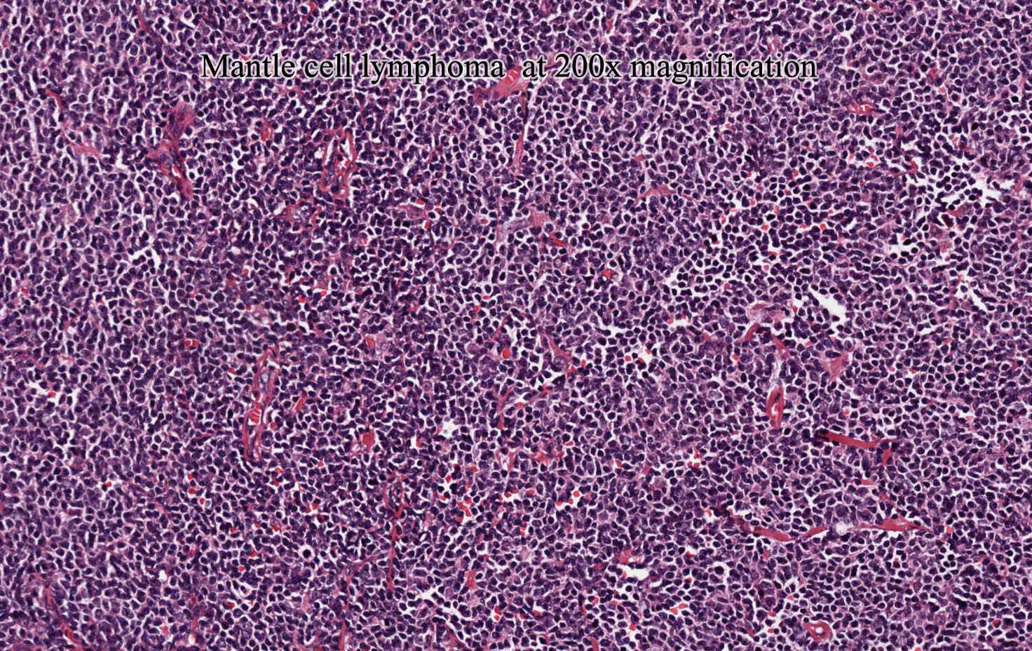 Mantle cell lymphoma  at 200x magnification